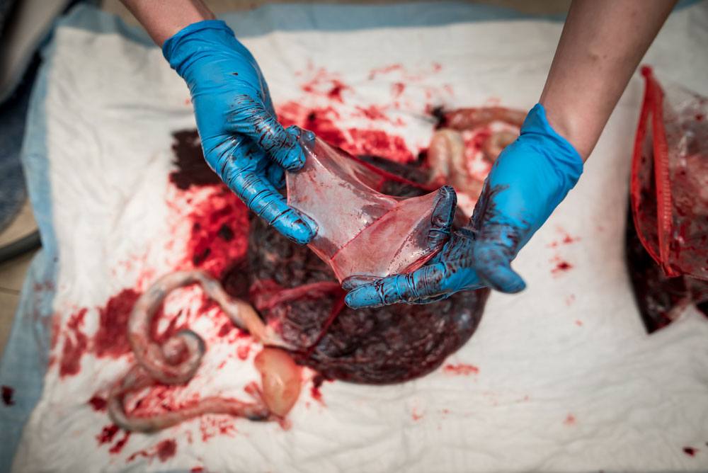 Twin placenta showing the divide between amniotic sacs
